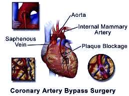 Top Surgeon for Heart Bypass Surgery