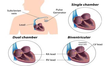 Principaux chirurgiens pour la chirurgie de pacemaker en Inde