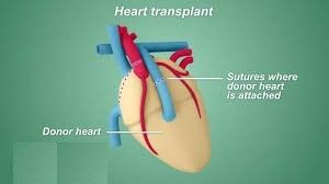 Top Surgeons Performing Heart Transplant Surgery
