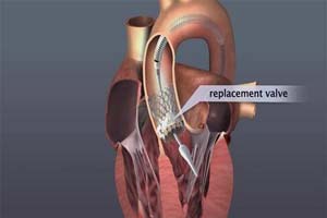 Top Surgeons Performing TAVI/TAVR Surgery at best hospitals in India