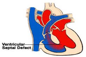 Top Ventricular Septal Defect Surgeons in India