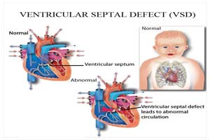 Ventricular Septal Defect Surgery at Top Hospitals in India