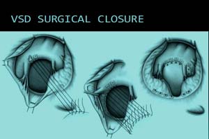 Ventricular Septal Defect (vsd) Surgery in India Reviews