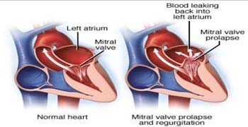 Best Hospitals Heart Valve Repair Surgery in India