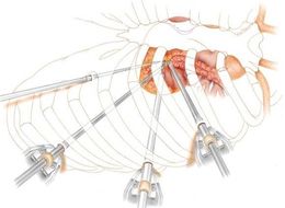 Cost of Minimally Invasive Heart Surgery in India