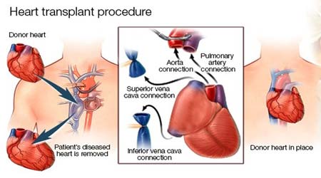 Heart Transplant Surgery in India