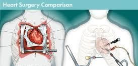 Top Hospitals Minimally Invasive Heart Surgery in India