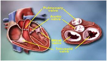 Top Surgeons Heart Valve Repair Surgery in India