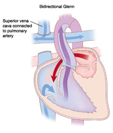 bidirectional glenn surgery cost india