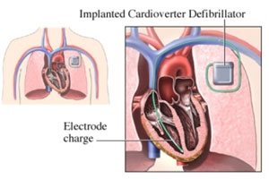 Défibrillateur automatique implantable – Institut de cardiologie
