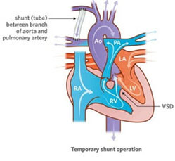 BT Shunt Treatment in India