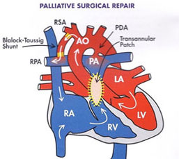 BT Shunt Procedure