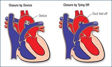 PDA Closure Surgery In India