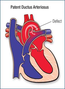 PDA abordable Ligation Surgery Hôpitaux Chirurgiens Inde