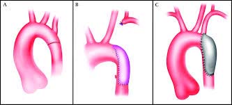 Best Price Coarctation Of Aorta Surgery Congenital Defect Hospitals in India