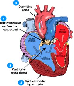 Best Price Tetralogy Of Fallot Of tof top Surgeons Best Hospitals India