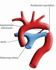 Coarctation of Aorta 