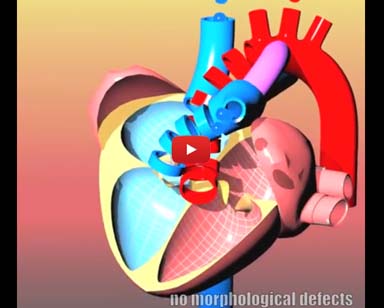 Congenital heart defects