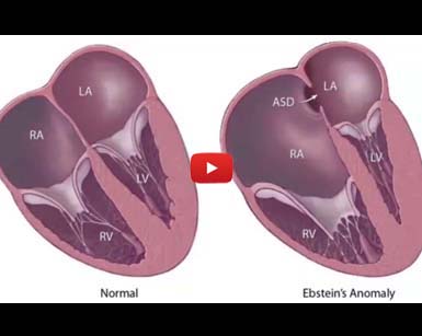 Ebstein anomaly Video One