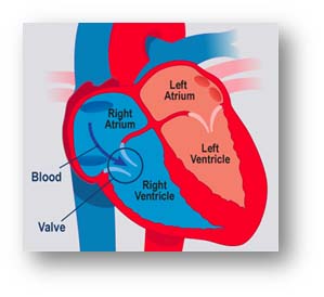 Low-Cost Effective Ebstein Anomaly Defect Surgery in India