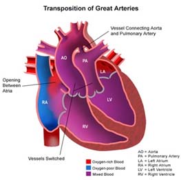Transposition of Great Arteries Cost India