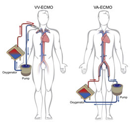 What happens in ECMO treatment