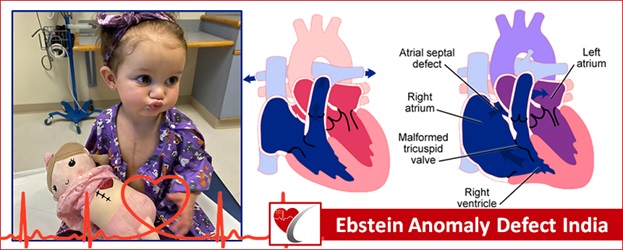 Natural History of Asymptomatic and Unrepaired Vascular Rings: Is Watchful  Waiting a Viable Option? A New Case and Review of Pre