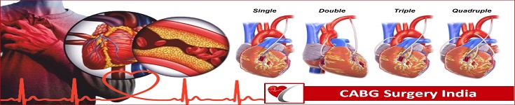 coronary-artery-bypass-graft-surgery-india