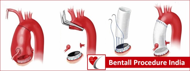 bental-cardiac-surgery-india