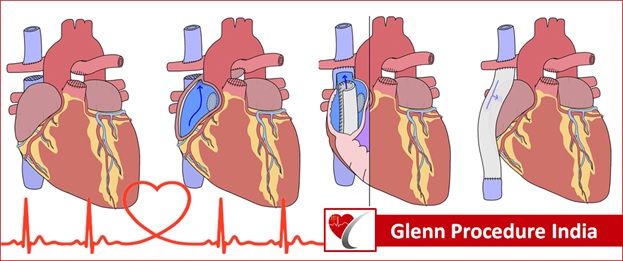 bidirectional-glenn-surgery-in-india