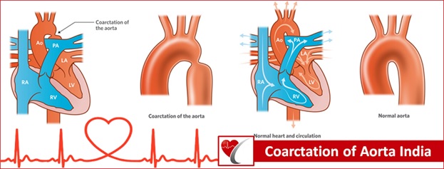 coarctation-of-aorta-surgry-india