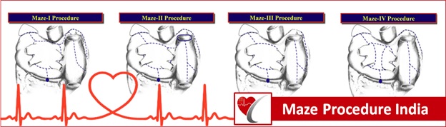 maze-surgery-for-atrial-fibrillation-best-cardiac-india